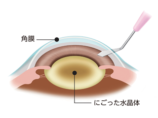白内障の治療1